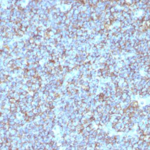 Formalin-fixed, paraffin-embedded human Ewing&apos;s Sarcoma stained with CD99 Monoclonal Antibody (SPM596).