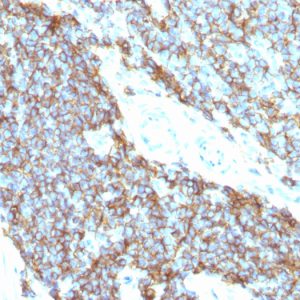 Formalin-fixed, paraffin-embedded human Ewing&apos;s sarcoma stained with CD99 Monoclonal Antibody (12E7+MIC2/877).