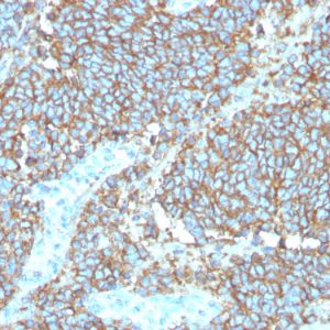 Formalin-fixed, paraffin-embedded human Ewing&apos;s Sarcoma stained with CD99 Recombinant Mouse Monoclonal Antibody (rMIC2/3317).