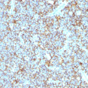 Formalin-fixed, paraffin-embedded human Ewing&apos;s Sarcoma stained with CD99 Rabbit Recombinant Monoclonal Antibody (MIC2/1495R).