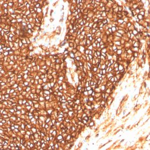 Formalin-fixed, paraffin-embedded human Ewing&apos;s Sarcoma stained with CD99 Rabbit Recombinant Monoclonal Antibody (MIC2/3478R).