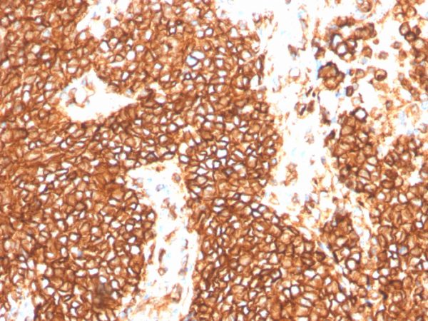 Formalin-fixed, paraffin-embedded human Ewing&apos;s Sarcoma stained with CD99 Rabbit Recombinant Monoclonal Antibody (MIC2/3478R).