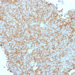 Formalin-fixed, paraffin-embedded human Ewing&apos;s Sarcoma (EWS) stained with CD99 Rabbit Polyclonal Antibody.