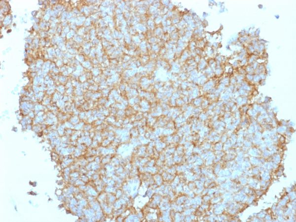 Formalin-fixed, paraffin-embedded human Ewing&apos;s Sarcoma (EWS) stained with CD99 Rabbit Polyclonal Antibody.