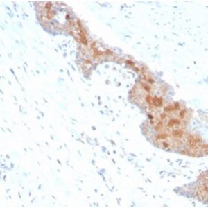 Formalin-fixed, paraffin-embedded human prostate stained with MIF Mouse Monoclonal Antibody (MIF/4336). HIER: Tris/EDTA, pH9.0, 45min. 2°C: HRP-polymer, 30min. DAB, 5min.
