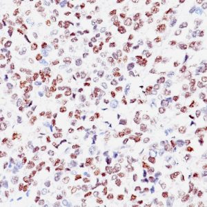 Formalin-fixed, paraffin-embedded human Melanoma stained with MITF Mouse Monoclonal Antibody (SPM290)