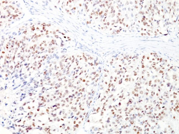 Formalin-fixed, paraffin-embedded human Melanoma stained with MITF Monoclonal Antibody (D5 + MITF/915).