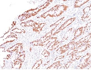 Formalin-fixed, paraffin-embedded human colon carcinoma stained with MLH1 Mouse Monoclonal Antibody (G168-728).