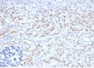FFPE Lynch Syndrome / Hereditary Non-Polyposis Colorectal Cancer (HNPCC). MLH1 Recombinant Rabbit Monoclonal (MLH1/6284R).  Inset: PBS instead of primary antibody; secondary only negative control.
