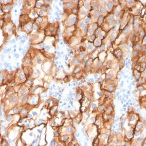 Formalin-fixed, paraffin-embedded human Renal Cell Carcinoma stained with CD10 Mouse Monoclonal Antibody (MME/2579).