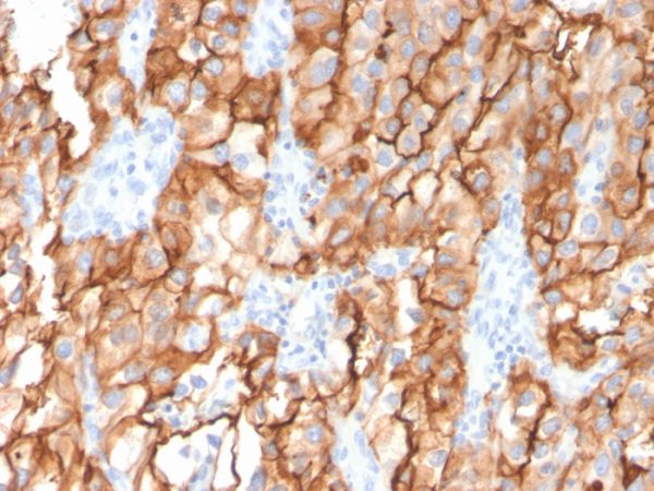 Formalin-fixed, paraffin-embedded human Renal Cell Carcinoma stained with CD10 Mouse Monoclonal Antibody (MME/2579).