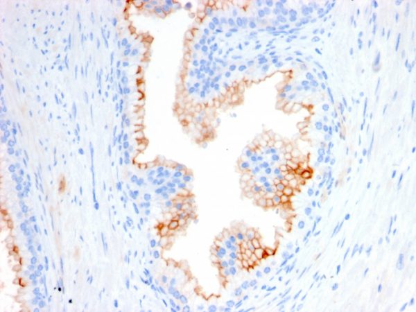 Formalin-fixed, paraffin-embedded human Prostate Carcinoma stained with CD10 Mouse Monoclonal Antibody (MME/2580).