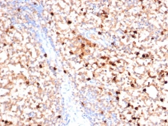 Formalin-fixed, paraffin-embedded human bone marrow stained with Myeloperoxidase Mouse Monoclonal Antibody (MPO/7116). HIER: Tris/EDTA, pH9.0, 45min. 2°C: HRP-polymer, 30min. DAB, 5min.