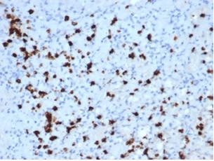 Formalin-fixed, paraffin-embedded human bone marrow stained with Myeloperoxidase Mouse Monoclonal Antibody (MPO/7118). HIER: Tris/EDTA, pH9.0, 45min. 2 °: HRP-polymer, 30min. DAB, 5min.