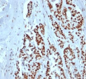 Formalin-fixed, paraffin-embedded human colon stained with MSH2 Recombinant Mouse Monoclonal Antibody (rMSH2/6548).