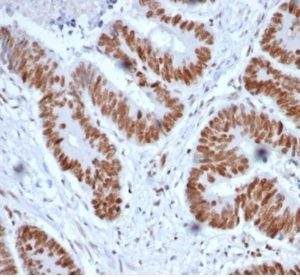 Formalin-fixed, paraffin-embedded human colon stained with MSH2 Mouse Monoclonal Antibody (MSH2/6852). HIER: Tris/EDTA, pH9.0, 45min. 2°C: HRP-polymer, 30min. DAB, 5min.