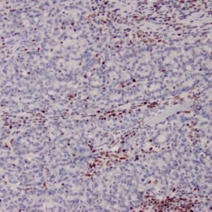 Formalin-fixed, paraffin-embedded human Colon from Lynch disease stained with MSH2 Mouse Monoclonal Antibody (MSH2/2622).