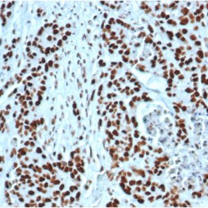Formalin-fixed, paraffin-embedded human colonstained with MSH2Recombinant Rabbit Monoclonal Antibody (MSH2/6549R).