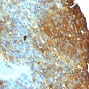 Formalin-fixed, paraffin-embedded human Melanoma stained with Moesin Mouse Monoclonal Antibody (SPM295)