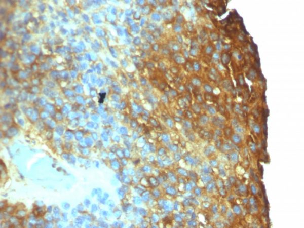 Formalin-fixed, paraffin-embedded human Melanoma stained with Moesin Mouse Monoclonal Antibody (SPM295)