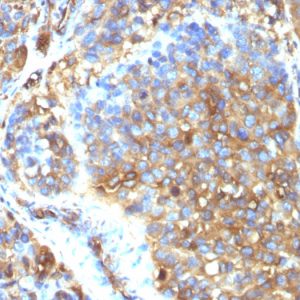 Formalin-fixed, paraffin-embedded human Melanoma stained with Moesin Mouse Monoclonal Antibody (MSN/493).