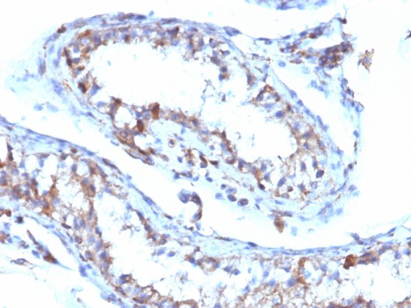 Formalin-fixed, paraffin-embedded human Testicular Carcinoma stained with Moesin Mouse Monoclonal Antibody (MSN/493).