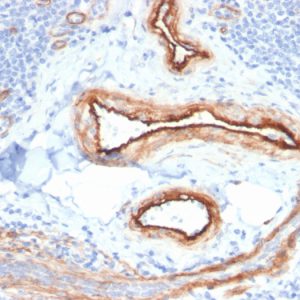 Formalin-fixed, paraffin-embedded human Renal Cell Carcinoma stained with MTF1 Mouse Monoclonal Antibody (MTF1/2649).