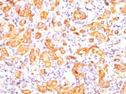 Formalin-fixed, paraffin-embedded human Breast Carcinoma stained with MUC-1 Mouse Monoclonal Antibody (GP1.4).