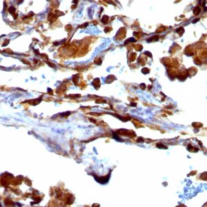 Formalin-fixed, paraffin-embedded human Lung Carcinoma stained with MUC-1 / CA15-3 / EMA Mouse Monoclonal Antibody (VU-4H5).