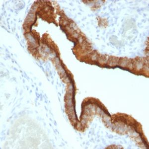 Formalin-fixed, paraffin-embedded human Ovarian Carcinoma stained with MUC-1 / CA15-3 / EMA Mouse Monoclonal Antibody (HMPV).