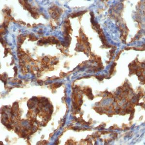 Formalin-fixed, paraffin-embedded human Ovarian Carcinoma stained with MUC-1 / CA15-3 / EMA Mouse Monoclonal Antibody (MUC1/955).