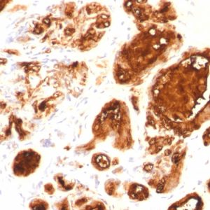 Formalin-fixed, paraffin-embedded human breast carcinoma stained with MUC1 Mouse Recombinant Monoclonal Antibody (rMUC1/960).