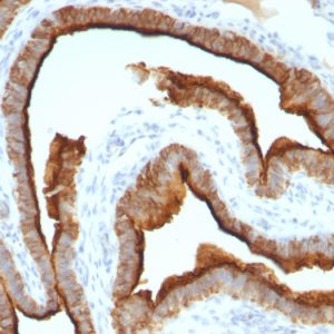 Formalin-fixed, paraffin-embedded human Ovarian Carcinoma stained with MUC-1 / CA15-3 / EMA Mouse Monoclonal Antibody (MUC1/967).