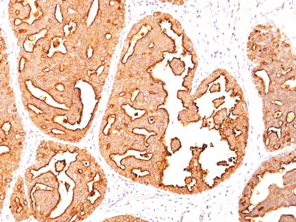 Formalin-fixed, paraffin-embedded human Breast Carcinoma stained with MUC-1 / CA15-3 / EMA Mouse Monoclonal Antibody (MUC1/967).