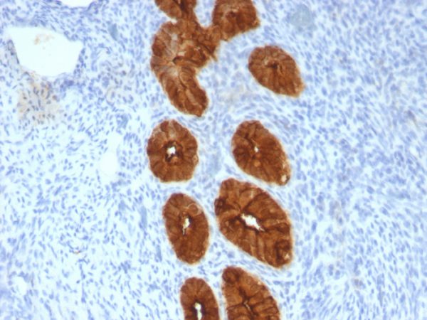 Formalin-fixed, paraffin-embedded human Endometrial Carcinoma stained with MUC-1 / CA15-3 / EMA Mouse Monoclonal Antibody (MUC1/967).