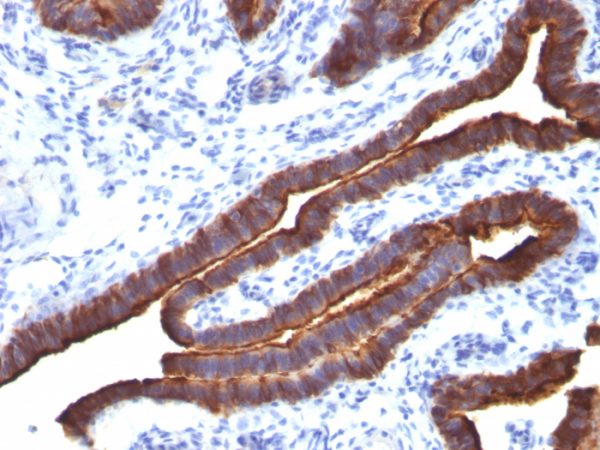 Formalin-fixed, paraffin-embedded human Ovarian Carcinoma stained with MUC-1 / CA15-3 / EMA Mouse Monoclonal Antibody (MUC1/520).