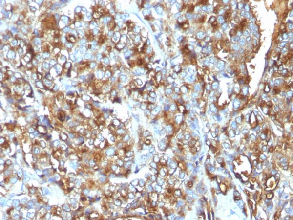 Formalin-fixed, paraffin-embedded human Breast Carcinoma stained with MUC-1 / EMA Mouse Monoclonal Antibody (MUC1/520).