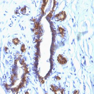 Formalin-fixed, paraffin-embedded human Breast Carcinoma stained with MUC-1 / CA15-3 / EMA Mouse Monoclonal Antibody (SPM132).