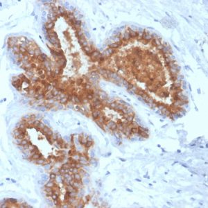 Formalin-fixed, paraffin-embedded human breast carcinoma stained with MUC-1 / EMA Recombinant Mouse Monoclonal Antibody (rMUC1/4418).