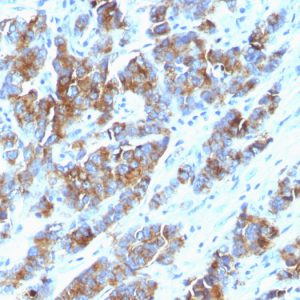 Formalin-fixed, paraffin-embedded human Breast Carcinoma stained with MUC-1 / CA15-3 / EMA Mouse Monoclonal Antibody (SPM533)