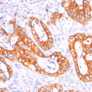 Formalin-fixed, paraffin-embedded human Colon Carcinoma stained with MUC-1 Mouse Monoclonal Antibody (GP1.4 + E29)