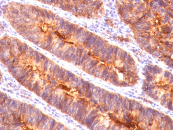 Formalin-fixed, paraffin-embedded human Colon Carcinoma stained with MUC-1 Mouse Monoclonal Antibody (MUC1/845).