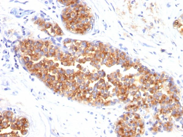 Formalin-fixed, paraffin-embedded human Breast Carcinoma stained with MUC-1 Mouse Monoclonal Antibody (MUC1/845).