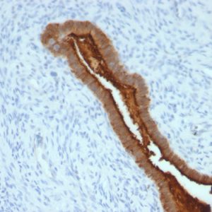 Formalin-fixed, paraffin-embedded human Endometrial Carcinoma stained with MUC-1 / CA15-3 / EMA Mouse Monoclonal Antibody (SPM492).