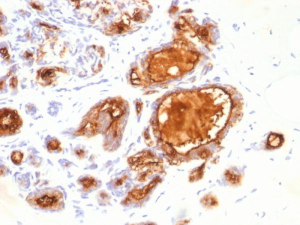 Formalin-fixed, paraffin-embedded human Breast Carcinoma stained with MUC1 Mouse Monoclonal Antibody (115D8).