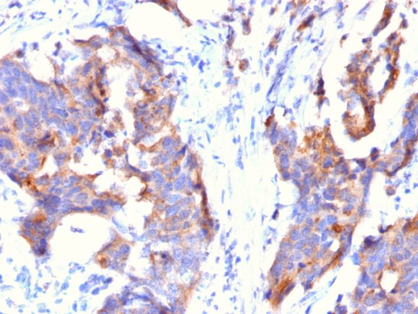 Formalin-fixed, paraffin-embedded human Stomach Carcinoma stained with MUC1 Mouse Monoclonal Antibody (115D8).