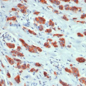 Formalin-fixed, paraffin-embedded human breast carcinoma stained with MUC1 Rabbit Recombinant Monoclonal Antibody (MUC1/1887R).