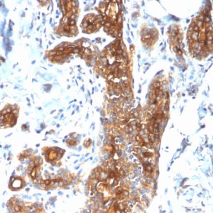 Formalin-fixed, paraffin-embedded human Breast Carcinoma stained with MUC1 Rabbit Recombinant Monoclonal Antibody (MUC1/2278R).