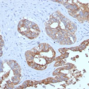 Formalin-fixed, paraffin-embedded human Prostate Carcinoma stained with MUC1 Recombinant Rabbit Monoclonal Antibody (MUC1/2729R).
