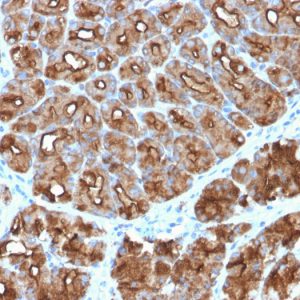 Formalin-fixed, paraffin-embedded human Stomach Carcinoma stained with MUC1 Rabbit Recombinant Monoclonal Antibody (MUC1/2818R).